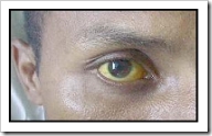 Ictericia (ojos amarillentos)