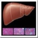 hepatitis-c-cirrosis-hepatica
