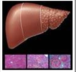 hepatitis-c-cirrosis-hepatica