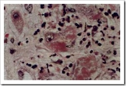 hepatitis