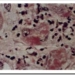hepatitis
