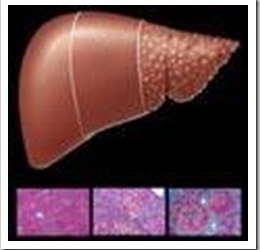hepatitis-c-cirrosis-hepatica