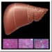 hepatitis-c-cirrosis-hepatica