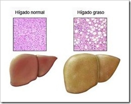 higado-graso