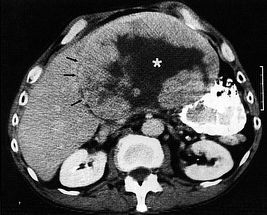 hepatocarcinoma-cancer-de-higado.jpg