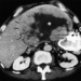 hepatocarcinoma-cancer-de-higado.jpg