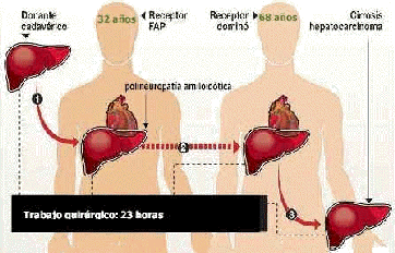 trasplante hepatico higado