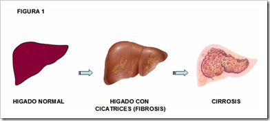 cirrosis fibrosis higado hepatica