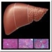 hepatitis-c-cirrosis-hepatica-thumb.jpg