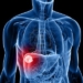 forma-de-cuerpo-humano-con-cancer-de-higado.jpg