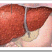cirrosis higado hepatica
