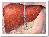 cirrosis higado hepatica