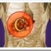 hepatitisCmexico