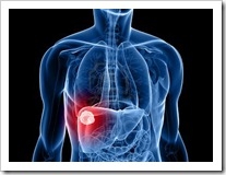 cancer de higado hepatocarcinoma