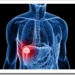 cancer de higado hepatocarcinoma
