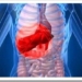 hepatitis-1
