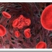 anemia-ferropenica-carencia-hierro