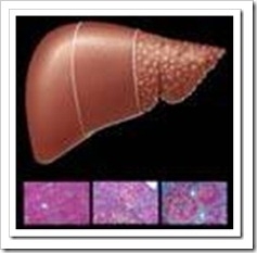 hepatitis-c-cirrosis-hepatica-a