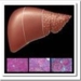 hepatitis-c-cirrosis-hepatica-a