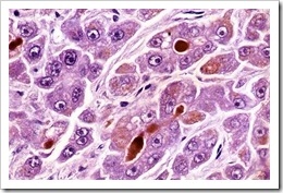 cancer-de-higado-hepatico