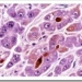 cancer-de-higado-hepatico