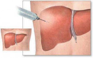 biopsia-hepatica-higado
