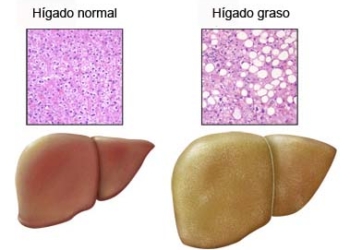 higado_graso