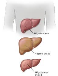 ehna-higado-graso
