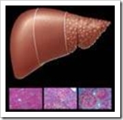 hepatitisccirrosishepatica-thumb3.jpg