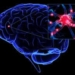 cerebro parkinson