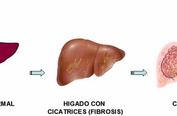 cirrosisfibrosishigadohepatica