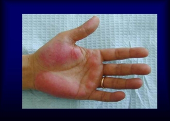 síntoma de cirrosis en las manos