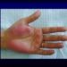 síntoma de cirrosis en las manos