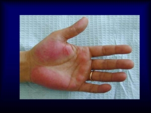 síntoma de cirrosis en las manos
