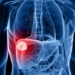 Signos-silenciosos-del-Cáncer-de-hígado-1.jpg