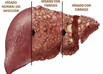estados-de-la-hepatitis.jpg