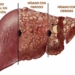 estados-de-la-hepatitis.jpg