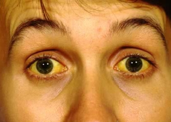 ictericia-hepatitis-a.jpg