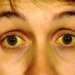 ictericia-hepatitis-a.jpg