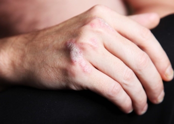 Nuevo-tratamiento-para-la-psoriasis.jpg