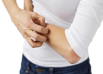 psoriasis.jpg_974135707.jpg