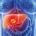Cancer-de-higado-sintomas-iniciales-y-tratamientos.jpg