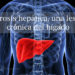cirrosis-hepatica.jpg