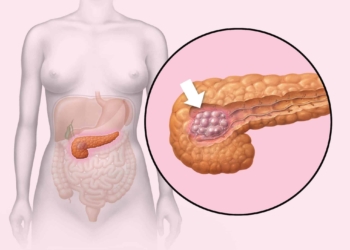 Cancer-de-pancreas.jpg