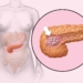 Cancer-de-pancreas.jpg