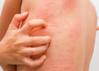 urticaria-hepatitis.jpg