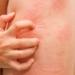 urticaria-hepatitis.jpg