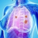 fármaco-cáncer-pulmón.jpg