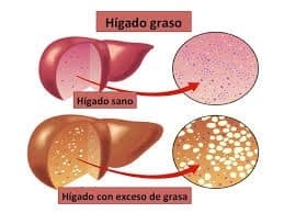 higado-graso222.jpg