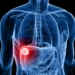 Cancer-de-higado.jpg
